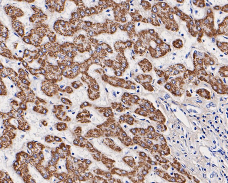 Immunohistochemical analysis of paraffin-embedded human liver tissue using anti-OTC/Ornithine Carbamoyltransferase antibody. The section was pre-treated using heat mediated antigen retrieval with Tris-EDTA buffer (pH 8.0-8.4) for 20 minutes.The tissues were blocked in 5% BSA for 30 minutes at room temperature, washed with ddH2O and PBS, and then probed with the primary antibody (HA500048, 1/400) for 30 minutes at room temperature. The detection was performed using an HRP conjugated compact polymer system. DAB was used as the chromogen. Tissues were counterstained with hematoxylin and mounted with DPX.