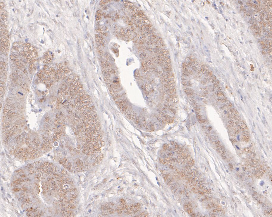 Immunohistochemical analysis of paraffin-embedded human colon carcinoma tissue using anti-ADK antibody. The section was pre-treated using heat mediated antigen retrieval with sodium citrate buffer (pH 6.0) for 20 minutes. The tissues were blocked in 5% BSA for 30 minutes at room temperature, washed with ddH2O and PBS, and then probed with the primary antibody (HA500050, 1/2,000)  for 30 minutes at room temperature. The detection was performed using an HRP conjugated compact polymer system. DAB was used as the chromogen. Tissues were counterstained with hematoxylin and mounted with DPX.