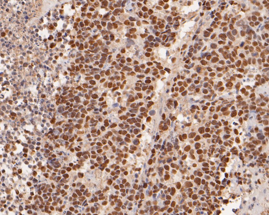 Immunohistochemical analysis of paraffin-embedded human lung carcinoma tissue using anti-ADK antibody. The section was pre-treated using heat mediated antigen retrieval with sodium citrate buffer (pH 6.0) for 20 minutes. The tissues were blocked in 5% BSA for 30 minutes at room temperature, washed with ddH2O and PBS, and then probed with the primary antibody (HA500050, 1/2,000)  for 30 minutes at room temperature. The detection was performed using an HRP conjugated compact polymer system. DAB was used as the chromogen. Tissues were counterstained with hematoxylin and mounted with DPX.