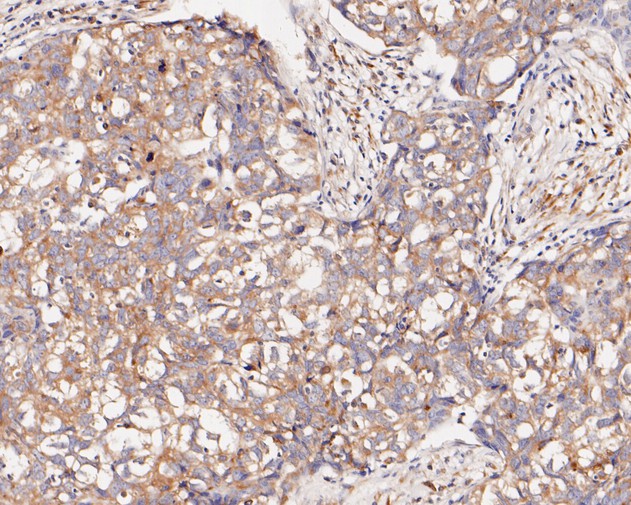 Immunohistochemical analysis of paraffin-embedded human breast carcinoma tissue using anti-ARF4 antibody. The section was pre-treated using heat mediated antigen retrieval with Tris-EDTA buffer (pH 8.0-8.4) for 20 minutes.The tissues were blocked in 5% BSA for 30 minutes at room temperature, washed with ddH2O and PBS, and then probed with the primary antibody (HA500066, 1/800) for 30 minutes at room temperature. The detection was performed using an HRP conjugated compact polymer system. DAB was used as the chromogen. Tissues were counterstained with hematoxylin and mounted with DPX.