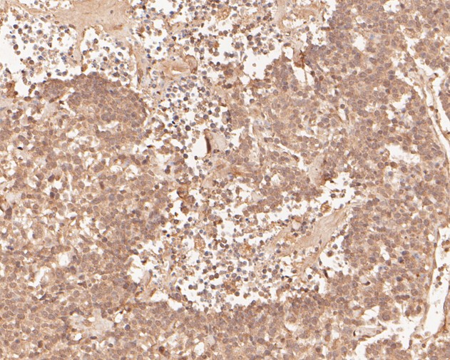 Immunohistochemical analysis of paraffin-embedded human lung carcinoma tissue using anti-PHLDA1 antibody. The section was pre-treated using heat mediated antigen retrieval with sodium citrate buffer (pH 6.0) for 20 minutes. The tissues were blocked in 5% BSA for 30 minutes at room temperature, washed with ddH2O and PBS, and then probed with the primary antibody (HA500068, 1/400)  for 30 minutes at room temperature. The detection was performed using an HRP conjugated compact polymer system. DAB was used as the chromogen. Tissues were counterstained with hematoxylin and mounted with DPX.