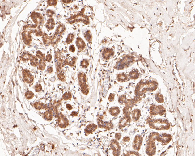 Immunohistochemical analysis of paraffin-embedded human breast tissue using anti-PHLDA1 antibody. The section was pre-treated using heat mediated antigen retrieval with sodium citrate buffer (pH 6.0) for 20 minutes. The tissues were blocked in 5% BSA for 30 minutes at room temperature, washed with ddH2O and PBS, and then probed with the primary antibody (HA500068, 1/400)  for 30 minutes at room temperature. The detection was performed using an HRP conjugated compact polymer system. DAB was used as the chromogen. Tissues were counterstained with hematoxylin and mounted with DPX.