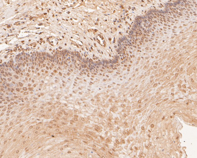 Immunohistochemical analysis of paraffin-embedded human esophagus tissue using anti-PHLDA1 antibody. The section was pre-treated using heat mediated antigen retrieval with sodium citrate buffer (pH 6.0) for 20 minutes. The tissues were blocked in 5% BSA for 30 minutes at room temperature, washed with ddH2O and PBS, and then probed with the primary antibody (HA500068, 1/400)  for 30 minutes at room temperature. The detection was performed using an HRP conjugated compact polymer system. DAB was used as the chromogen. Tissues were counterstained with hematoxylin and mounted with DPX.
