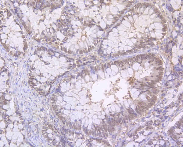 Immunohistochemical analysis of paraffin-embedded human colon carcinoma tissue using anti-RanBP1 antibody. The section was pre-treated using heat mediated antigen retrieval with sodium citrate buffer (pH 6.0) for 20 minutes. The tissues were blocked in 5% BSA for 30 minutes at room temperature, washed with ddH2O and PBS, and then probed with the primary antibody (HA500069, 1/1,000)  for 30 minutes at room temperature. The detection was performed using an HRP conjugated compact polymer system. DAB was used as the chromogen. Tissues were counterstained with hematoxylin and mounted with DPX.