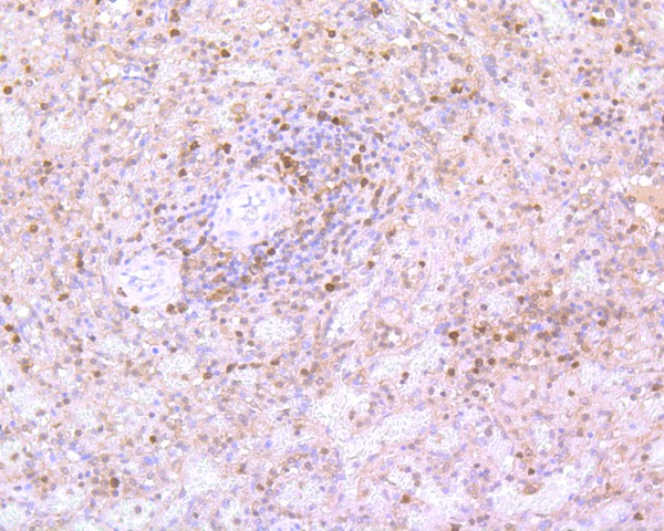 Immunohistochemical analysis of paraffin-embedded human spleen tissue using anti-Caspase-3 antibody. The section was pre-treated using heat mediated antigen retrieval with Tris-EDTA buffer (pH 8.0-8.4) for 20 minutes.The tissues were blocked in 5% BSA for 30 minutes at room temperature, washed with ddH2O and PBS, and then probed with the primary antibody (ET1602-39, 1/50) for 30 minutes at room temperature. The detection was performed using an HRP conjugated compact polymer system. DAB was used as the chromogen. Tissues were counterstained with hematoxylin and mounted with DPX.