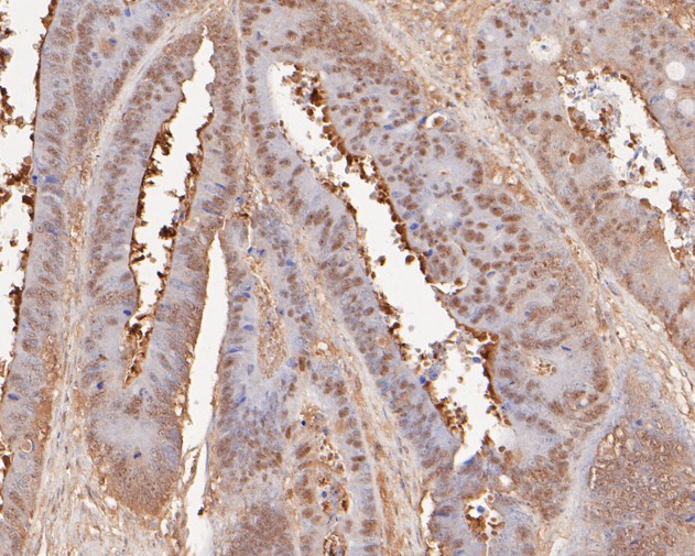 Immunohistochemical analysis of paraffin-embedded human colon carcinoma tissue using anti-ONECUT3 antibody. The section was pre-treated using heat mediated antigen retrieval with sodium citrate buffer (pH 6.0) for 20 minutes. The tissues were blocked in 5% BSA for 30 minutes at room temperature, washed with ddH2O and PBS, and then probed with the primary antibody (HA500130, 1/100)  for 30 minutes at room temperature. The detection was performed using an HRP conjugated compact polymer system. DAB was used as the chromogen. Tissues were counterstained with hematoxylin and mounted with DPX.