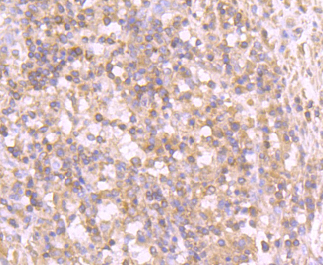 Immunohistochemical analysis of paraffin-embedded human stomach carcinoma tissue using anti-Tyrosinase antibody. The section was pre-treated using heat mediated antigen retrieval with Tris-EDTA buffer (pH 8.0-8.4) for 20 minutes.The tissues were blocked in 5% BSA for 30 minutes at room temperature, washed with ddH2O and PBS, and then probed with the primary antibody (ET1704-18, 1/50) for 30 minutes at room temperature. The detection was performed using an HRP conjugated compact polymer system. DAB was used as the chromogen. Tissues were counterstained with hematoxylin and mounted with DPX.