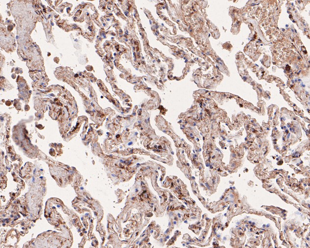 Immunohistochemical analysis of paraffin-embedded human lung tissue using anti-GABA A Receptor beta 3 antibody. The section was pre-treated using heat mediated antigen retrieval with Tris-EDTA buffer (pH 8.0-8.4) for 20 minutes.The tissues were blocked in 5% BSA for 30 minutes at room temperature, washed with ddH2O and PBS, and then probed with the primary antibody (HA500090, 1/400) for 30 minutes at room temperature. The detection was performed using an HRP conjugated compact polymer system. DAB was used as the chromogen. Tissues were counterstained with hematoxylin and mounted with DPX.