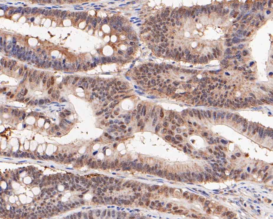 Immunohistochemical analysis of paraffin-embedded Human colon cancer tissue using anti-PCBP1 antibody. The section was pre-treated using heat mediated antigen retrieval with sodium citrate buffer (pH 6.0) for 20 minutes. The tissues were blocked in 5% BSA for 30 minutes at room temperature, washed with ddH2O and PBS, and then probed with the primary antibody (HA600019, 1/400) for 30 minutes at room temperature. The detection was performed using an HRP conjugated compact polymer system. DAB was used as the chromogen. Tissues were counterstained with hematoxylin and mounted with DPX.