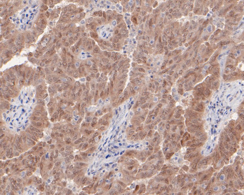 Immunohistochemical analysis of paraffin-embedded human ovarian serous carcinoma tissue using anti-p16INK4a antibody. The section was pre-treated using heat mediated antigen retrieval with sodium citrate buffer (pH 6.0) for 20 minutes. The tissues were blocked in 5% BSA for 30 minutes at room temperature, washed with ddH2O and PBS, and then probed with the primary antibody (HA600027, 1/400)  for 30 minutes at room temperature. The detection was performed using an HRP conjugated compact polymer system. DAB was used as the chromogen. Tissues were counterstained with hematoxylin and mounted with DPX.