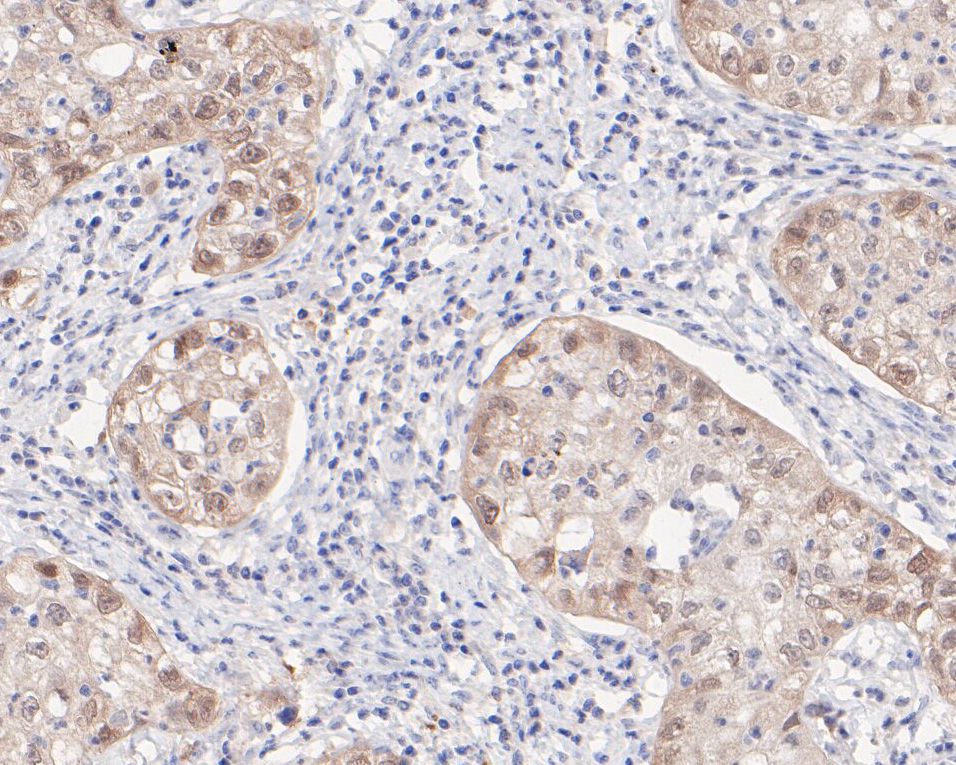 Immunohistochemical analysis of paraffin-embedded human cervical poorly differentiated adenocarcinoma tissue using anti-p16INK4a antibody. The section was pre-treated using heat mediated antigen retrieval with sodium citrate buffer (pH 6.0) for 20 minutes. The tissues were blocked in 5% BSA for 30 minutes at room temperature, washed with ddH2O and PBS, and then probed with the primary antibody (HA600027, 1/200)  for 30 minutes at room temperature. The detection was performed using an HRP conjugated compact polymer system. DAB was used as the chromogen. Tissues were counterstained with hematoxylin and mounted with DPX.