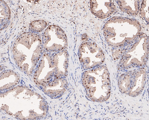Immunohistochemical analysis of paraffin-embedded human prostate tissue using anti-PP1C gamma antibody. The section was pre-treated using heat mediated antigen retrieval with sodium citrate buffer (pH 6.0) for 20 minutes. The tissues were blocked in 5% BSA for 30 minutes at room temperature, washed with ddH2O and PBS, and then probed with the primary antibody (HA500138, 1/100)  for 30 minutes at room temperature. The detection was performed using an HRP conjugated compact polymer system. DAB was used as the chromogen. Tissues were counterstained with hematoxylin and mounted with DPX.