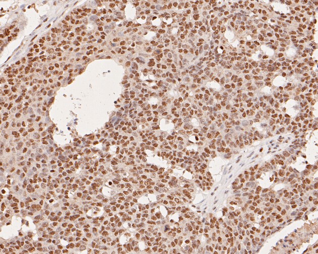 Immunohistochemical analysis of paraffin-embedded human ovarian tumor tissue using anti-THOC5 antibody. The section was pre-treated using heat mediated antigen retrieval with sodium citrate buffer (pH 6.0) for 20 minutes. The tissues were blocked in 5% BSA for 30 minutes at room temperature, washed with ddH2O and PBS, and then probed with the primary antibody (HA500129, 1/800)  for 30 minutes at room temperature. The detection was performed using an HRP conjugated compact polymer system. DAB was used as the chromogen. Tissues were counterstained with hematoxylin and mounted with DPX.