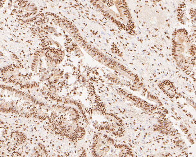 Immunohistochemical analysis of paraffin-embedded human colon carcinoma tissue using anti-XPA antibody. The section was pre-treated using heat mediated antigen retrieval with sodium citrate buffer (pH 6.0) for 20 minutes. The tissues were blocked in 5% BSA for 30 minutes at room temperature, washed with ddH2O and PBS, and then probed with the primary antibody (HA500133, 1/400)  for 30 minutes at room temperature. The detection was performed using an HRP conjugated compact polymer system. DAB was used as the chromogen. Tissues were counterstained with hematoxylin and mounted with DPX.
