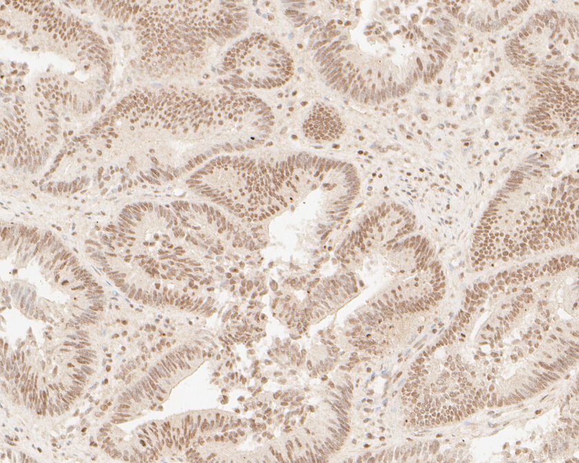 Immunohistochemical analysis of paraffin-embedded human colon carcinoma tissue using anti-HNRPDL antibody. The section was pre-treated using heat mediated antigen retrieval with sodium citrate buffer (pH 6.0) for 20 minutes. The tissues were blocked in 5% BSA for 30 minutes at room temperature, washed with ddH2O and PBS, and then probed with the primary antibody (HA500146, 1/400)  for 30 minutes at room temperature. The detection was performed using an HRP conjugated compact polymer system. DAB was used as the chromogen. Tissues were counterstained with hematoxylin and mounted with DPX.