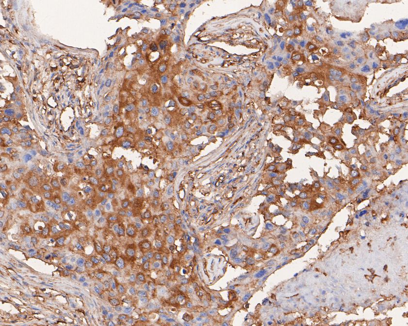 Immunohistochemical analysis of paraffin-embedded human breast carcinoma tissue using anti-ARPC2 antibody. The section was pre-treated using heat mediated antigen retrieval with sodium citrate buffer (pH 6.0) for 20 minutes. The tissues were blocked in 5% BSA for 30 minutes at room temperature, washed with ddH2O and PBS, and then probed with the primary antibody (HA720030, 1/200)  for 30 minutes at room temperature. The detection was performed using an HRP conjugated compact polymer system. DAB was used as the chromogen. Tissues were counterstained with hematoxylin and mounted with DPX.
