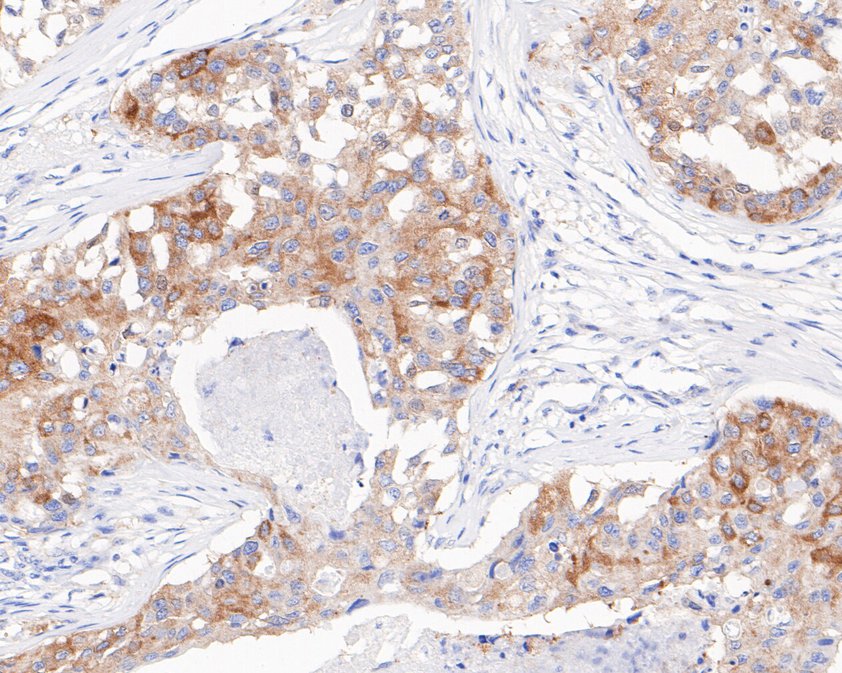 Immunohistochemical analysis of paraffin-embedded human breast carcinoma tissue using anti-ZPR1 antibody. The section was pre-treated using heat mediated antigen retrieval with sodium citrate buffer (pH 6.0) for 20 minutes. The tissues were blocked in 5% BSA for 30 minutes at room temperature, washed with ddH2O and PBS, and then probed with the primary antibody (HA720026, 1/200)  for 30 minutes at room temperature. The detection was performed using an HRP conjugated compact polymer system. DAB was used as the chromogen. Tissues were counterstained with hematoxylin and mounted with DPX.