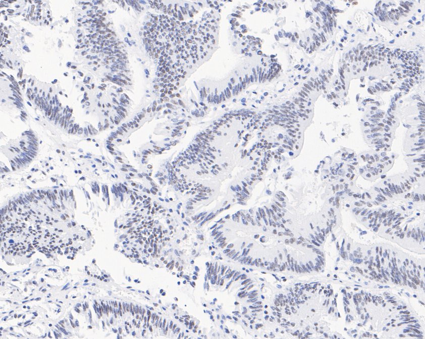 Immunohistochemical analysis of paraffin-embedded human colon carcinoma tissue using anti-USP39 antibody. The section was pre-treated using heat mediated antigen retrieval with sodium citrate buffer (pH 6.0) for 20 minutes. The tissues were blocked in 5% BSA for 30 minutes at room temperature, washed with ddH2O and PBS, and then probed with the primary antibody (HA720034, 1/200)  for 30 minutes at room temperature. The detection was performed using an HRP conjugated compact polymer system. DAB was used as the chromogen. Tissues were counterstained with hematoxylin and mounted with DPX.