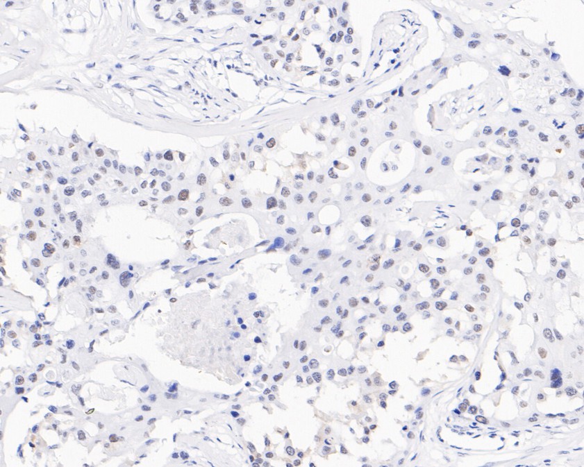Immunohistochemical analysis of paraffin-embedded human breast carcinoma tissue using anti-USP39 antibody. The section was pre-treated using heat mediated antigen retrieval with sodium citrate buffer (pH 6.0) for 20 minutes. The tissues were blocked in 5% BSA for 30 minutes at room temperature, washed with ddH2O and PBS, and then probed with the primary antibody (HA720034, 1/200)  for 30 minutes at room temperature. The detection was performed using an HRP conjugated compact polymer system. DAB was used as the chromogen. Tissues were counterstained with hematoxylin and mounted with DPX.