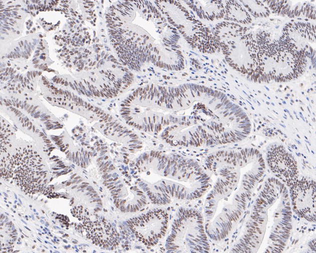 Immunohistochemical analysis of paraffin-embedded human colon carcinoma tissue using anti-Phospho-ATM (S1981) antibody. The section was pre-treated using heat mediated antigen retrieval with sodium citrate buffer (pH 6.0) for 20 minutes. The tissues were blocked in 5% BSA for 30 minutes at room temperature, washed with ddH2O and PBS, and then probed with the primary antibody (ET1705-50, 1/200)  for 30 minutes at room temperature. The detection was performed using an HRP conjugated compact polymer system. DAB was used as the chromogen. Tissues were counterstained with hematoxylin and mounted with DPX.