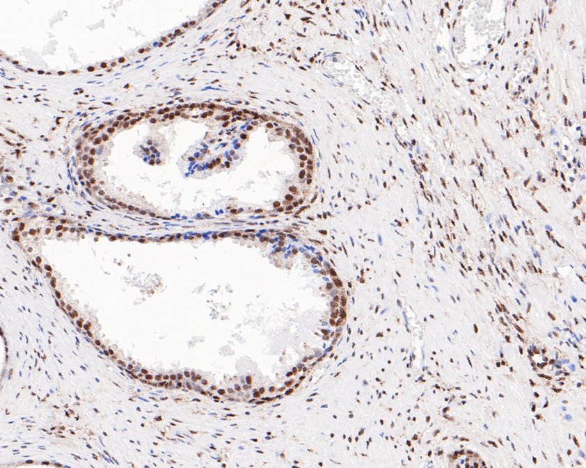 Immunohistochemical analysis of paraffin-embedded human prostate tissue using anti-Phospho-ATF2(T71) antibody. The section was pre-treated using heat mediated antigen retrieval with sodium citrate buffer (pH 6.0) for 20 minutes. The tissues were blocked in 5% BSA for 30 minutes at room temperature, washed with ddH2O and PBS, and then probed with the primary antibody (ET1610-30, 1/200)  for 30 minutes at room temperature. The detection was performed using an HRP conjugated compact polymer system. DAB was used as the chromogen. Tissues were counterstained with hematoxylin and mounted with DPX.