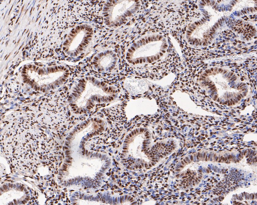 Immunohistochemical analysis of paraffin-embedded human uterus tissue using anti-Phospho-ATF2(T71) antibody. The section was pre-treated using heat mediated antigen retrieval with sodium citrate buffer (pH 6.0) for 20 minutes. The tissues were blocked in 5% BSA for 30 minutes at room temperature, washed with ddH2O and PBS, and then probed with the primary antibody (ET1610-30, 1/200)  for 30 minutes at room temperature. The detection was performed using an HRP conjugated compact polymer system. DAB was used as the chromogen. Tissues were counterstained with hematoxylin and mounted with DPX.