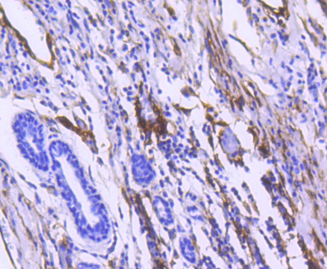 Immunohistochemical analysis of paraffin-embedded human breast carcinoma tissue using anti-CD90 antibody. The section was pre-treated using heat mediated antigen retrieval with Tris-EDTA buffer (pH 8.0-8.4) for 20 minutes.The tissues were blocked in 5% BSA for 30 minutes at room temperature, washed with ddH2O and PBS, and then probed with the primary antibody (ET1608-46, 1/50) for 30 minutes at room temperature. The detection was performed using an HRP conjugated compact polymer system. DAB was used as the chromogen. Tissues were counterstained with hematoxylin and mounted with DPX.
