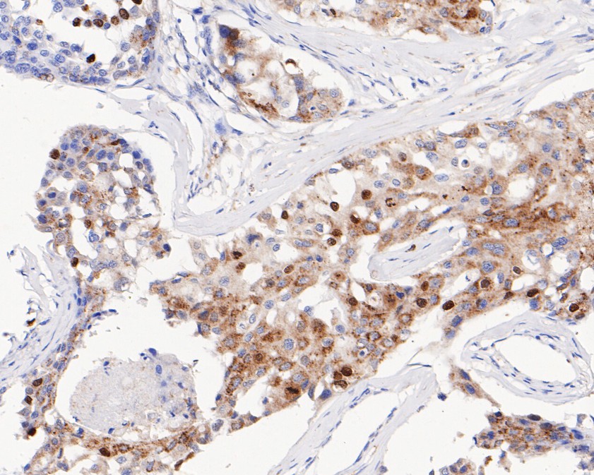 Immunohistochemical analysis of paraffin-embedded human breast carcinoma tissue using anti-Phospho-Histone H1.3(T17)+Histone H1.4(T17) antibody. The section was pre-treated using heat mediated antigen retrieval with sodium citrate buffer (pH 6.0) for 20 minutes. The tissues were blocked in 5% BSA for 30 minutes at room temperature, washed with ddH2O and PBS, and then probed with the primary antibody (ET1602-11, 1/200)  for 30 minutes at room temperature. The detection was performed using an HRP conjugated compact polymer system. DAB was used as the chromogen. Tissues were counterstained with hematoxylin and mounted with DPX.