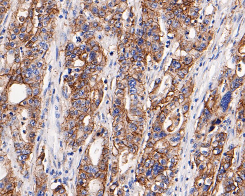 Immunohistochemical analysis of paraffin-embedded human gastric carcinoma tissue using anti-Claudin18 antibody. The section was pre-treated using heat mediated antigen retrieval with Tris-EDTA buffer (pH 9.0) for 20 minutes.The tissues were blocked in 5% BSA for 30 minutes at room temperature, washed with ddH2O and PBS, and then probed with the primary antibody (HA500131, 1/200) for 30 minutes at room temperature. The detection was performed using an HRP conjugated compact polymer system. DAB was used as the chromogen. Tissues were counterstained with hematoxylin and mounted with DPX.
