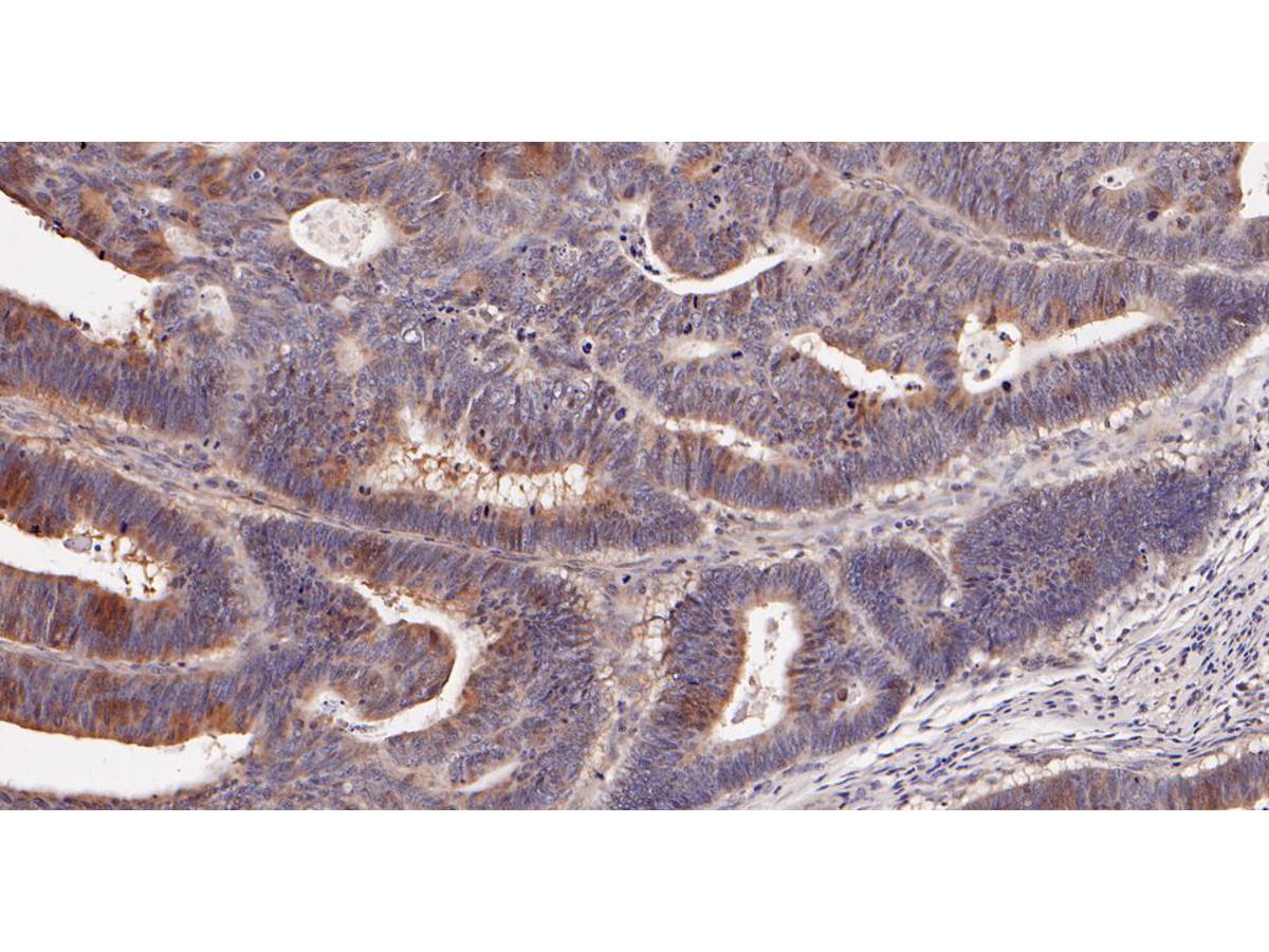 Immunohistochemical analysis of paraffin-embedded human colon carcinoma tissue using anti-AMPS antibody. The section was pre-treated using heat mediated antigen retrieval with Tris-EDTA buffer (pH 8.0-8.4) for 20 minutes.The tissues were blocked in 5% BSA for 30 minutes at room temperature, washed with ddH2O and PBS, and then probed with the primary antibody (HA500092, 1/800) for 30 minutes at room temperature. The detection was performed using an HRP conjugated compact polymer system. DAB was used as the chromogen. Tissues were counterstained with hematoxylin and mounted with DPX.