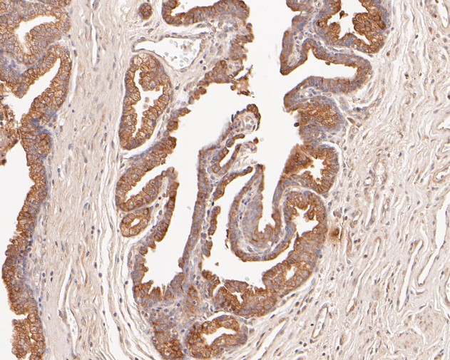 Immunohistochemical analysis of paraffin-embedded human prostate carcinoma tissue using anti-Cytokeratin 18 antibody. The section was pre-treated using heat mediated antigen retrieval with Tris-EDTA buffer (pH 8.0-8.4) for 20 minutes.The tissues were blocked in 5% BSA for 30 minutes at room temperature, washed with ddH2O and PBS, and then probed with the primary antibody (HA600020, 1/400) for 30 minutes at room temperature. The detection was performed using an HRP conjugated compact polymer system. DAB was used as the chromogen. Tissues were counterstained with hematoxylin and mounted with DPX.