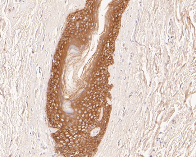 Immunohistochemical analysis of paraffin-embedded human prostate carcinoma tissue using anti-Cytokeratin 18 antibody. The section was pre-treated using heat mediated antigen retrieval with Tris-EDTA buffer (pH 8.0-8.4) for 20 minutes.The tissues were blocked in 5% BSA for 30 minutes at room temperature, washed with ddH2O and PBS, and then probed with the primary antibody (HA600021, 1/400) for 30 minutes at room temperature. The detection was performed using an HRP conjugated compact polymer system. DAB was used as the chromogen. Tissues were counterstained with hematoxylin and mounted with DPX.