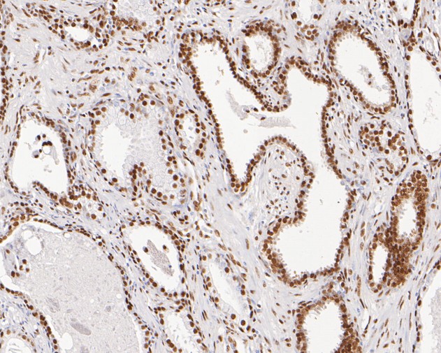 Immunohistochemical analysis of paraffin-embedded human prostate carcinoma tissue using anti-RRP42 antibody. The section was pre-treated using heat mediated antigen retrieval with sodium citrate buffer (pH 6.0) for 20 minutes. The tissues were blocked in 5% BSA for 30 minutes at room temperature, washed with ddH2O and PBS, and then probed with the primary antibody (ET7111-13, 1/50)  for 30 minutes at room temperature. The detection was performed using an HRP conjugated compact polymer system. DAB was used as the chromogen. Tissues were counterstained with hematoxylin and mounted with DPX.