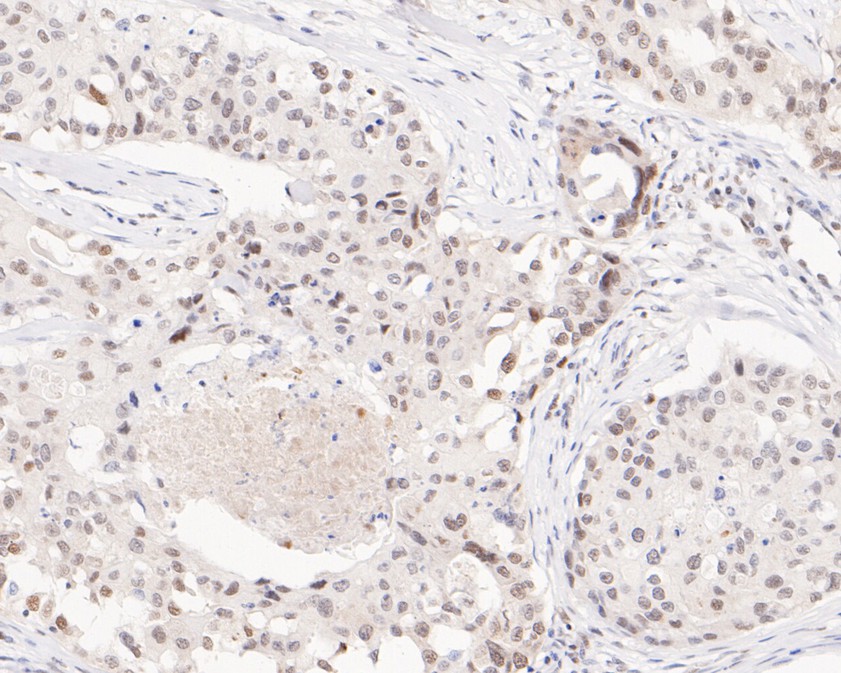 Immunohistochemical analysis of paraffin-embedded human breast carcinoma tissue using anti-hnRNP A1 antibody. The section was pre-treated using heat mediated antigen retrieval with sodium citrate buffer (pH 6.0) for 20 minutes. The tissues were blocked in 5% BSA for 30 minutes at room temperature, washed with ddH2O and PBS, and then probed with the primary antibody (ET1704-52, 1/200)  for 30 minutes at room temperature. The detection was performed using an HRP conjugated compact polymer system. DAB was used as the chromogen. Tissues were counterstained with hematoxylin and mounted with DPX.