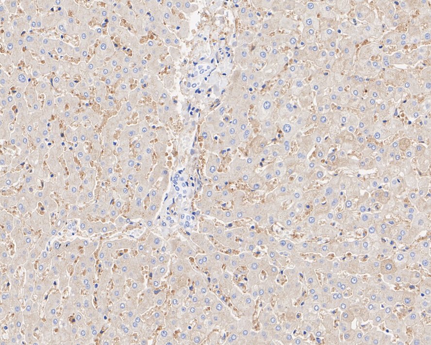 Immunohistochemical analysis of paraffin-embedded human liver tissue with Rabbit anti-Ferritin Heavy Chain antibody (ET1705-55) at 1/1,000 dilution.<br />
<br />
The section was pre-treated using heat mediated antigen retrieval with Tris-EDTA buffer (pH 9.0) for 20 minutes. The tissues were blocked in 1% BSA for 20 minutes at room temperature, washed with ddH2O and PBS, and then probed with the primary antibody (ET1705-55) at 1/1,000 dilution for 1 hour at room temperature. The detection was performed using an HRP conjugated compact polymer system. DAB was used as the chromogen. Tissues were counterstained with hematoxylin and mounted with DPX.
