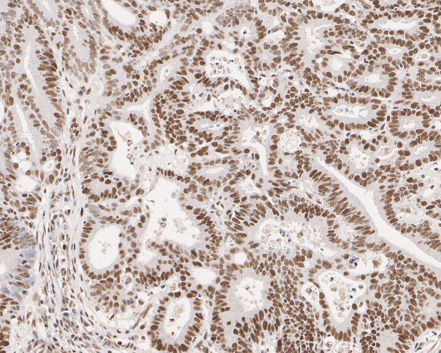 Immunohistochemical analysis of paraffin-embedded human colon cancer tissue with Mouse anti-MSH2 antibody (EM1801-05) at 1/1,000 dilution.<br />
<br />
The section was pre-treated using heat mediated antigen retrieval with sodium citrate buffer (pH 6.0) for 2 minutes. The tissues were blocked in 1% BSA for 20 minutes at room temperature, washed with ddH2O and PBS, and then probed with the primary antibody (EM1801-05) at 1/1,000 dilution for 1 hour at room temperature. The detection was performed using an HRP conjugated compact polymer system. DAB was used as the chromogen. Tissues were counterstained with hematoxylin and mounted with DPX.