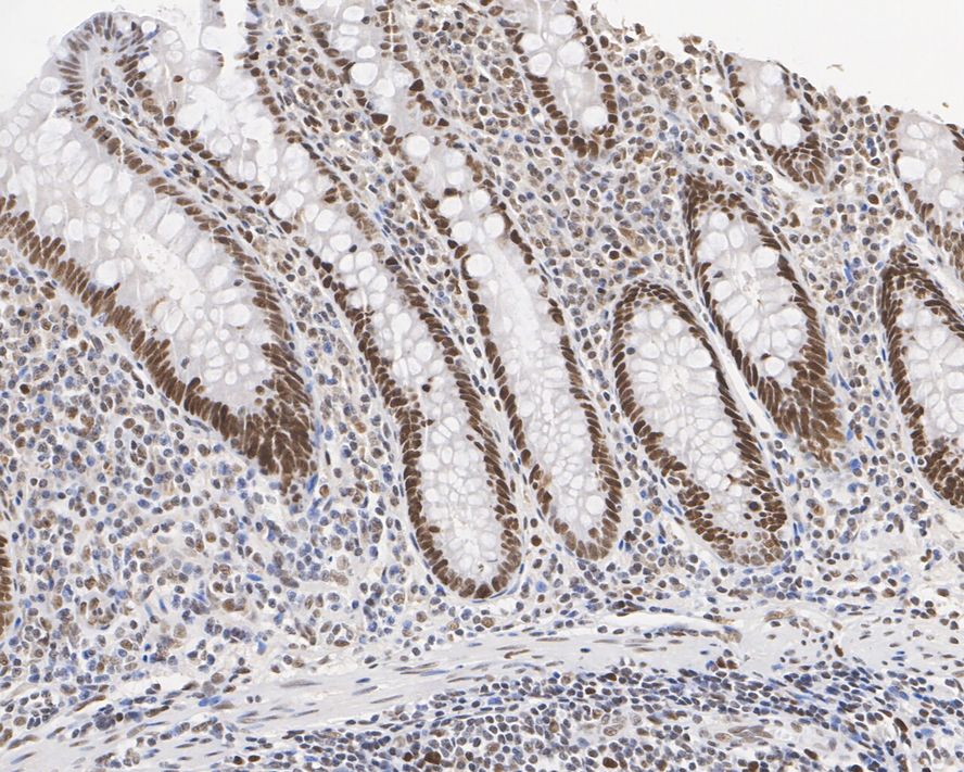 Immunohistochemical analysis of paraffin-embedded human appendix tissue with Mouse anti-MSH2 antibody (EM1801-05) at 1/1,000 dilution.<br />
<br />
The section was pre-treated using heat mediated antigen retrieval with sodium citrate buffer (pH 6.0) for 2 minutes. The tissues were blocked in 1% BSA for 20 minutes at room temperature, washed with ddH2O and PBS, and then probed with the primary antibody (EM1801-05) at 1/1,000 dilution for 1 hour at room temperature. The detection was performed using an HRP conjugated compact polymer system. DAB was used as the chromogen. Tissues were counterstained with hematoxylin and mounted with DPX.