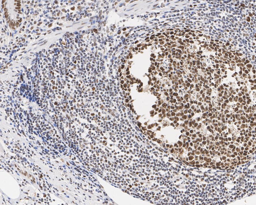 Immunohistochemical analysis of paraffin-embedded human appendicular lymph nodes tissue with Mouse anti-MSH2 antibody (EM1801-05) at 1/1,000 dilution.<br />
<br />
The section was pre-treated using heat mediated antigen retrieval with sodium citrate buffer (pH 6.0) for 2 minutes. The tissues were blocked in 1% BSA for 20 minutes at room temperature, washed with ddH2O and PBS, and then probed with the primary antibody (EM1801-05) at 1/1,000 dilution for 1 hour at room temperature. The detection was performed using an HRP conjugated compact polymer system. DAB was used as the chromogen. Tissues were counterstained with hematoxylin and mounted with DPX.