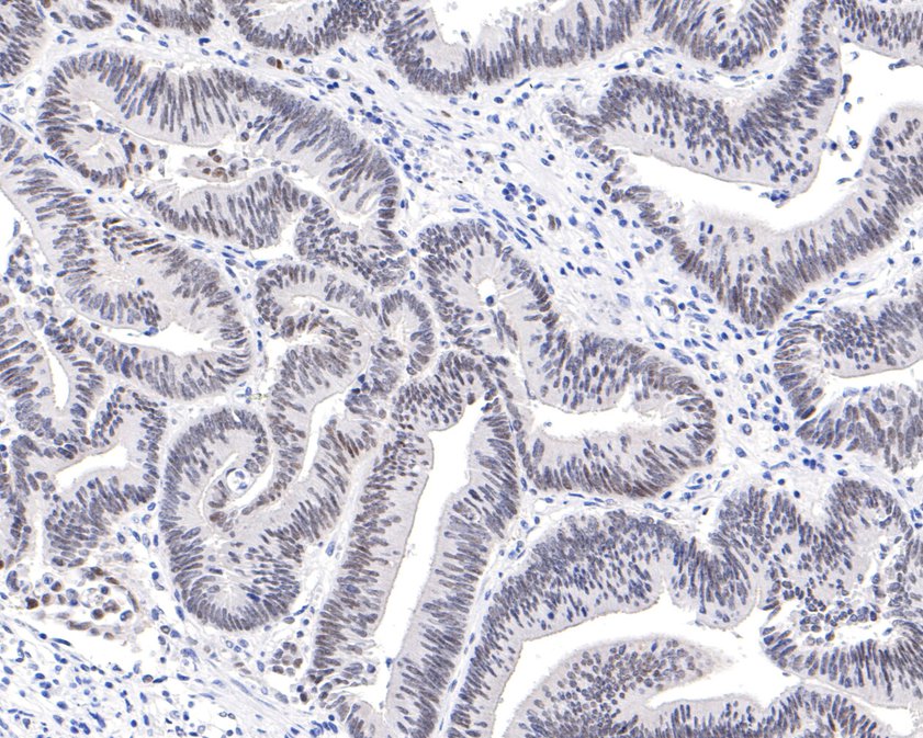 Immunohistochemical analysis of paraffin-embedded human colon carcinoma tissue using anti-SIRT6 antibody. The section was pre-treated using heat mediated antigen retrieval with sodium citrate buffer (pH 6.0) for 20 minutes. The tissues were blocked in 1% BSA for 30 minutes at room temperature, washed with ddH2O and PBS, and then probed with the primary antibody (ET1701-29, 1/400)  for 30 minutes at room temperature. The detection was performed using an HRP conjugated compact polymer system. DAB was used as the chromogen. Tissues were counterstained with hematoxylin and mounted with DPX.