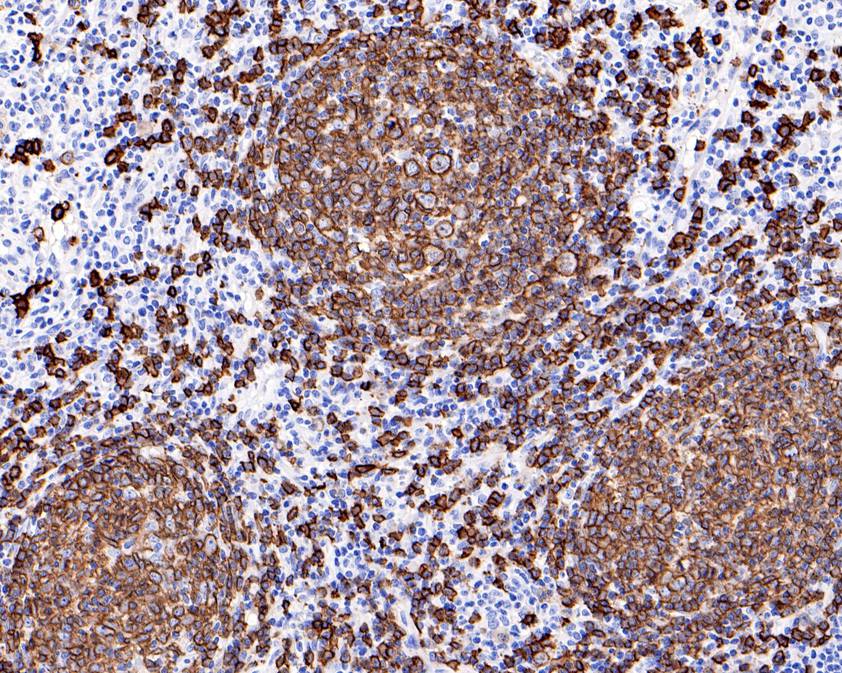 Immunohistochemical analysis of paraffin-embedded B-cell lymphoma tissue using anti-CD20 antibody. The section was pre-treated using heat mediated antigen retrieval with Tris-EDTA buffer (pH 8.0-8.4) for 20 minutes.The tissues were blocked in 5% BSA for 30 minutes at room temperature, washed with ddH2O and PBS, and then probed with the primary antibody (ET1605-33, 1/200) for 30 minutes at room temperature. The detection was performed using an HRP conjugated compact polymer system. DAB was used as the chromogen. Tissues were counterstained with hematoxylin and mounted with DPX.