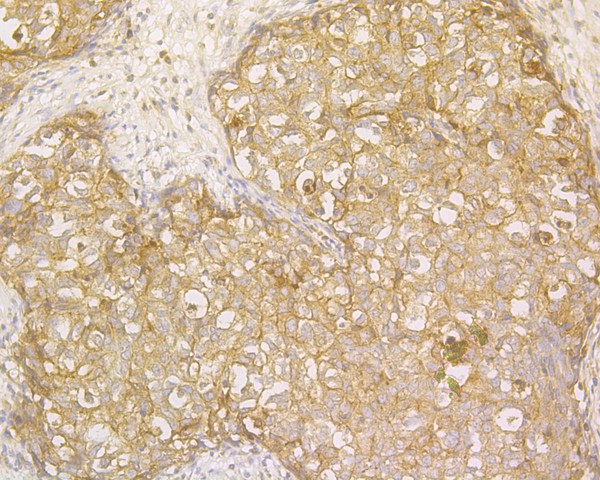 Immunohistochemical analysis of paraffin-embedded human breast carcinoma tissue using anti-ENAH antibody. The section was pre-treated using heat mediated antigen retrieval with Tris-EDTA buffer (pH 9.0) for 20 minutes.The tissues were blocked in 5% BSA for 30 minutes at room temperature, washed with ddH2O and PBS, and then probed with the primary antibody (HA500168, 1/800) for 30 minutes at room temperature. The detection was performed using an HRP conjugated compact polymer system. DAB was used as the chromogen. Tissues were counterstained with hematoxylin and mounted with DPX.