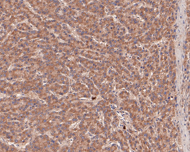 Immunohistochemical analysis of paraffin-embedded human liver carcinoma tissue using anti-LIM Kinase 1 antibody. The section was pre-treated using heat mediated antigen retrieval with Tris-EDTA buffer (pH 8.0-8.4) for 20 minutes.The tissues were blocked in 5% BSA for 30 minutes at room temperature, washed with ddH2O and PBS, and then probed with the primary antibody (HA500189, 1/200) for 30 minutes at room temperature. The detection was performed using an HRP conjugated compact polymer system. DAB was used as the chromogen. Tissues were counterstained with hematoxylin and mounted with DPX.