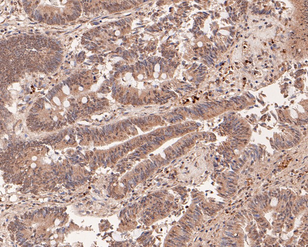 Immunohistochemical analysis of paraffin-embedded human colon carcinoma tissue using anti-LIM Kinase 1 antibody. The section was pre-treated using heat mediated antigen retrieval with Tris-EDTA buffer (pH 8.0-8.4) for 20 minutes.The tissues were blocked in 5% BSA for 30 minutes at room temperature, washed with ddH2O and PBS, and then probed with the primary antibody (HA500189, 1/200) for 30 minutes at room temperature. The detection was performed using an HRP conjugated compact polymer system. DAB was used as the chromogen. Tissues were counterstained with hematoxylin and mounted with DPX.