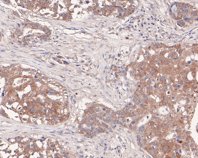 Immunohistochemical analysis of paraffin-embedded human breast carcinoma tissue using anti-LIM Kinase 1 antibody. The section was pre-treated using heat mediated antigen retrieval with Tris-EDTA buffer (pH 8.0-8.4) for 20 minutes.The tissues were blocked in 5% BSA for 30 minutes at room temperature, washed with ddH2O and PBS, and then probed with the primary antibody (HA500189, 1/200) for 30 minutes at room temperature. The detection was performed using an HRP conjugated compact polymer system. DAB was used as the chromogen. Tissues were counterstained with hematoxylin and mounted with DPX.