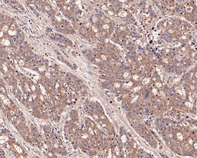 Immunohistochemical analysis of paraffin-embedded human stomach carcinoma tissue using anti-LIM Kinase 1 antibody. The section was pre-treated using heat mediated antigen retrieval with Tris-EDTA buffer (pH 8.0-8.4) for 20 minutes.The tissues were blocked in 5% BSA for 30 minutes at room temperature, washed with ddH2O and PBS, and then probed with the primary antibody (HA500189, 1/200) for 30 minutes at room temperature. The detection was performed using an HRP conjugated compact polymer system. DAB was used as the chromogen. Tissues were counterstained with hematoxylin and mounted with DPX.