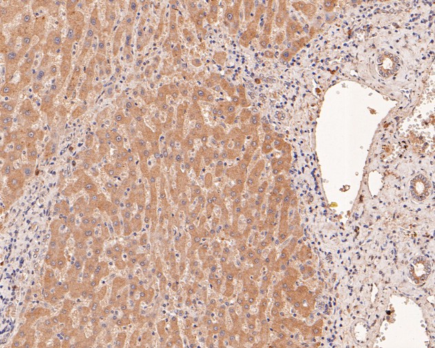 Immunohistochemical analysis of paraffin-embedded human liver tissue using anti-IL-32 antibody. The section was pre-treated using heat mediated antigen retrieval with Tris-EDTA buffer (pH 9.0) for 20 minutes.The tissues were blocked in 5% BSA for 30 minutes at room temperature, washed with ddH2O and PBS, and then probed with the primary antibody (HA500179, 1/1,500) for 30 minutes at room temperature. The detection was performed using an HRP conjugated compact polymer system. DAB was used as the chromogen. Tissues were counterstained with hematoxylin and mounted with DPX.