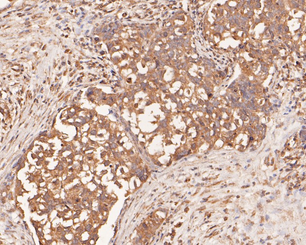 Immunohistochemical analysis of paraffin-embedded human breast carcinoma tissue using anti-IL-32 antibody. The section was pre-treated using heat mediated antigen retrieval with Tris-EDTA buffer (pH 9.0) for 20 minutes.The tissues were blocked in 5% BSA for 30 minutes at room temperature, washed with ddH2O and PBS, and then probed with the primary antibody (HA500179, 1/1,500) for 30 minutes at room temperature. The detection was performed using an HRP conjugated compact polymer system. DAB was used as the chromogen. Tissues were counterstained with hematoxylin and mounted with DPX.