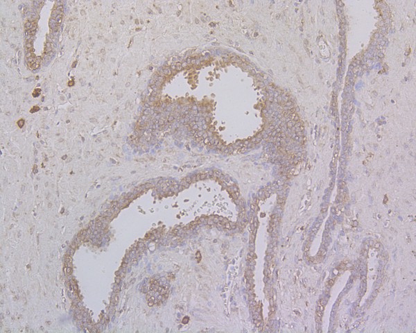Immunohistochemical analysis of paraffin-embedded human prostate carcinoma tissue using anti-MAP2 antibody. The section was pre-treated using heat mediated antigen retrieval with Tris-EDTA buffer (pH 8.0-8.4) for 20 minutes.The tissues were blocked in 5% BSA for 30 minutes at room temperature, washed with ddH2O and PBS, and then probed with the primary antibody (HA500177, 1/200) for 30 minutes at room temperature. The detection was performed using an HRP conjugated compact polymer system. DAB was used as the chromogen. Tissues were counterstained with hematoxylin and mounted with DPX.