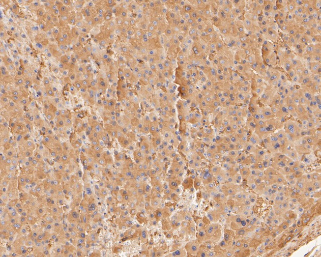 Immunohistochemical analysis of paraffin-embedded human liver carcinoma tissue using anti-COX5B antibody. The section was pre-treated using heat mediated antigen retrieval with Tris-EDTA buffer (pH 8.0-8.4) for 20 minutes.The tissues were blocked in 5% BSA for 30 minutes at room temperature, washed with ddH2O and PBS, and then probed with the primary antibody (HA500163, 1/50) for 30 minutes at room temperature. The detection was performed using an HRP conjugated compact polymer system. DAB was used as the chromogen. Tissues were counterstained with hematoxylin and mounted with DPX.