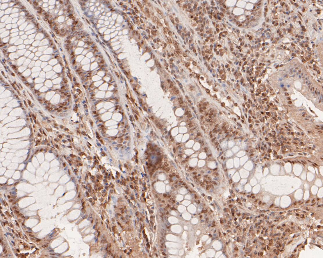 Immunohistochemical analysis of paraffin-embedded human colorectal carcinoma tissue using anti-SNRPD3 antibody. The section was pre-treated using heat mediated antigen retrieval with sodium citrate buffer (pH 6.0) for 20 minutes. The tissues were blocked in 5% BSA for 30 minutes at room temperature, washed with ddH2O and PBS, and then probed with the primary antibody (HA500254, 1/100)  for 30 minutes at room temperature. The detection was performed using an HRP conjugated compact polymer system. DAB was used as the chromogen. Tissues were counterstained with hematoxylin and mounted with DPX.